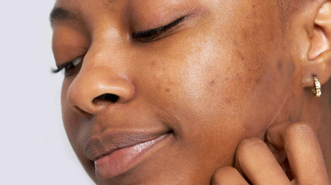 How breakouts help your skin